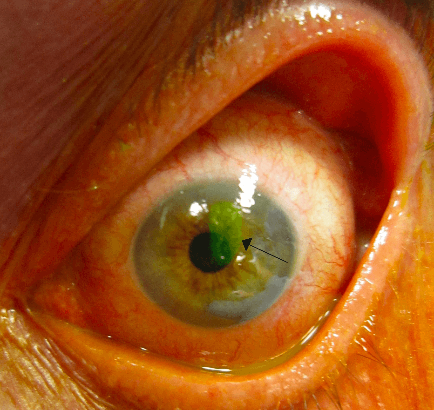 Corneal Abrasion
